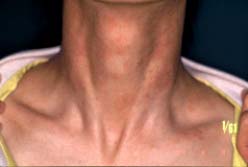 neck-2 weeks later