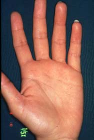 hand-1 year later
