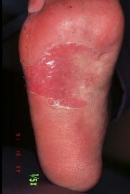 right sole-a month later