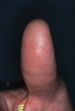 right thumb-6 months later